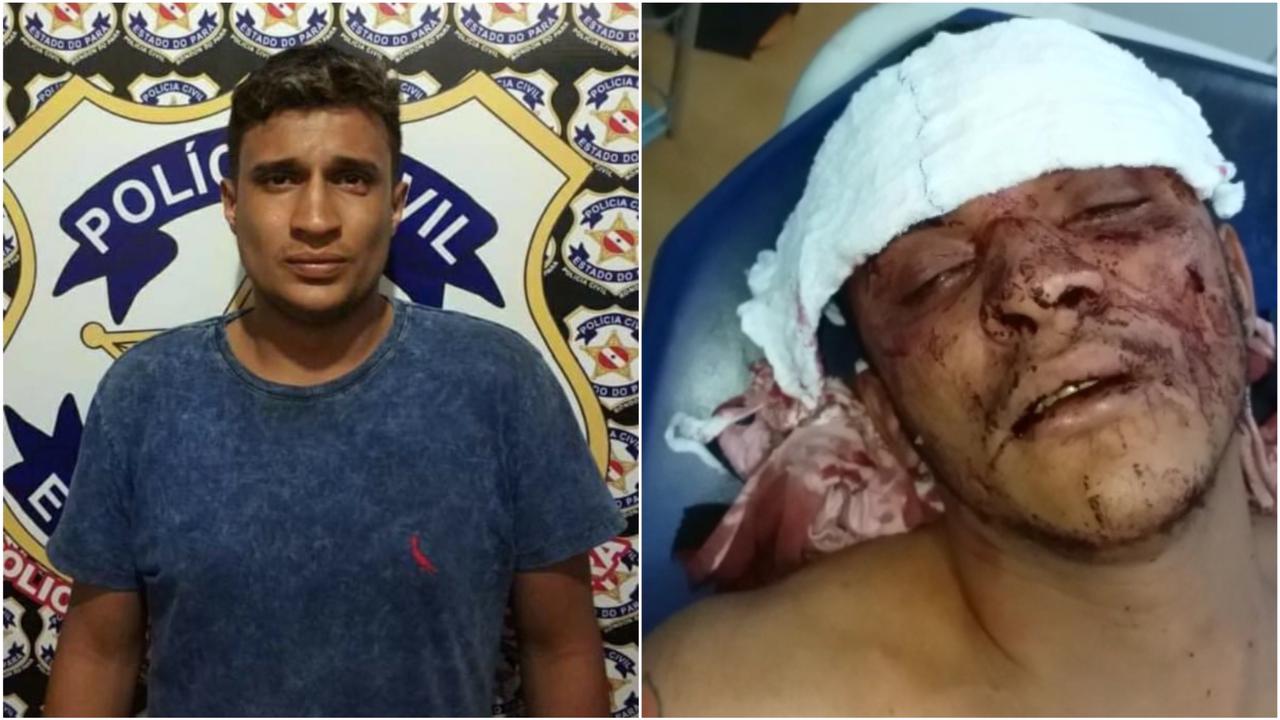“Gordurinha” é baleado na cabeça e revela suspeito quase morrendo no sudeste do Pará; assista