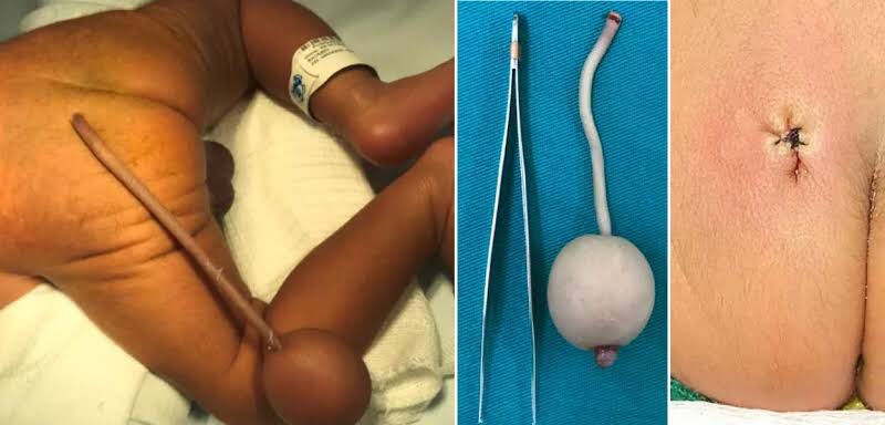 Bebê nasce prematuro e com ‘rabo de diabo’ no Ceará
