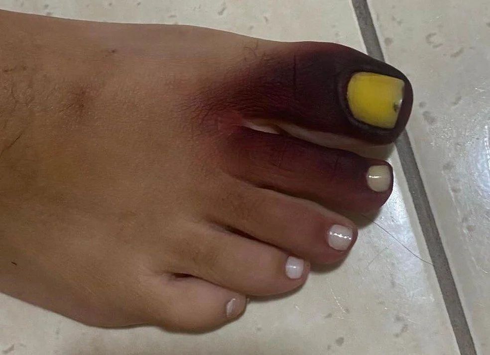 Mulher fica com pé roxo e unha amarela após calçar tênis com piolho-de-cobra
