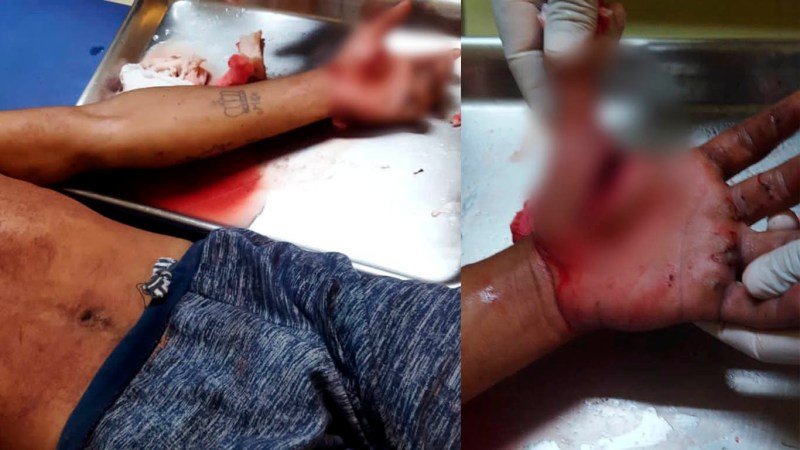 Jovem cai de bicicleta ao ouvir tiro e tem mão cortada por desconhecido