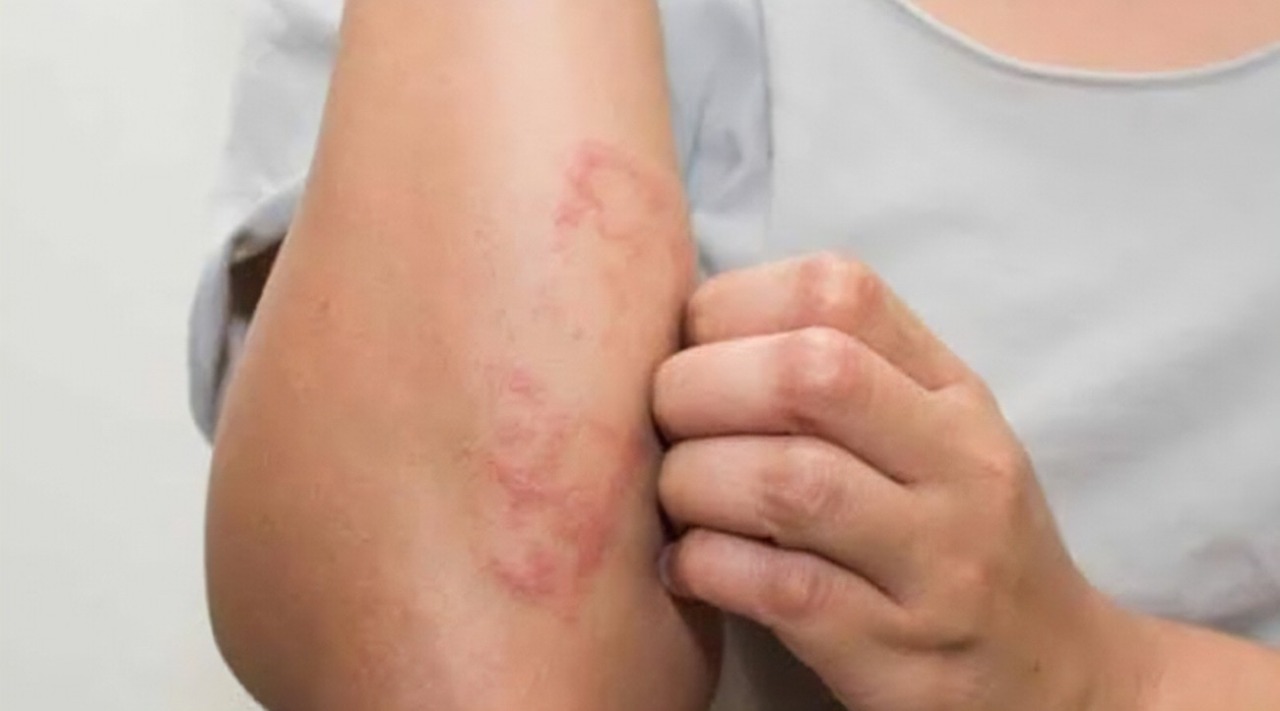 Pandemia faz notificações de hanseníase caírem 57% em 2021