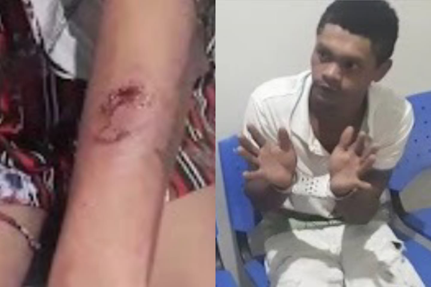 ‘Marido canibal’ morde companheira no sudeste do Pará