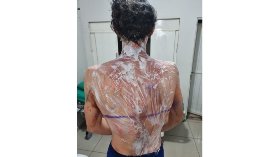 Calouros são queimados com creolina enquanto pediam dinheiro em semáforo