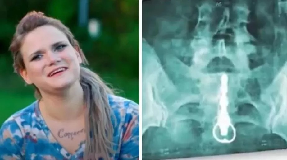 Mulher viciada em sexo é internada após vibrador ficar preso no reto: ‘Entrei em pânico’