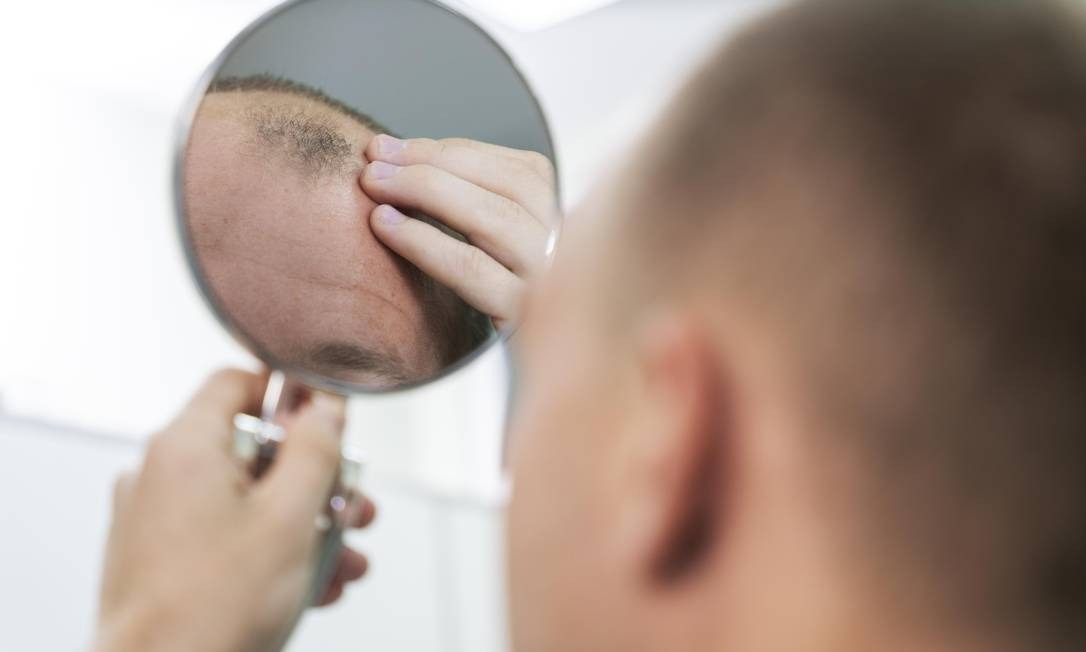 Alopecia: remédio para artrite faz cabelo voltar a crescer, mostra estudo