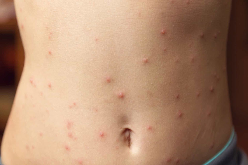 Sespa intensifica ações contra o sarampo no Pará
