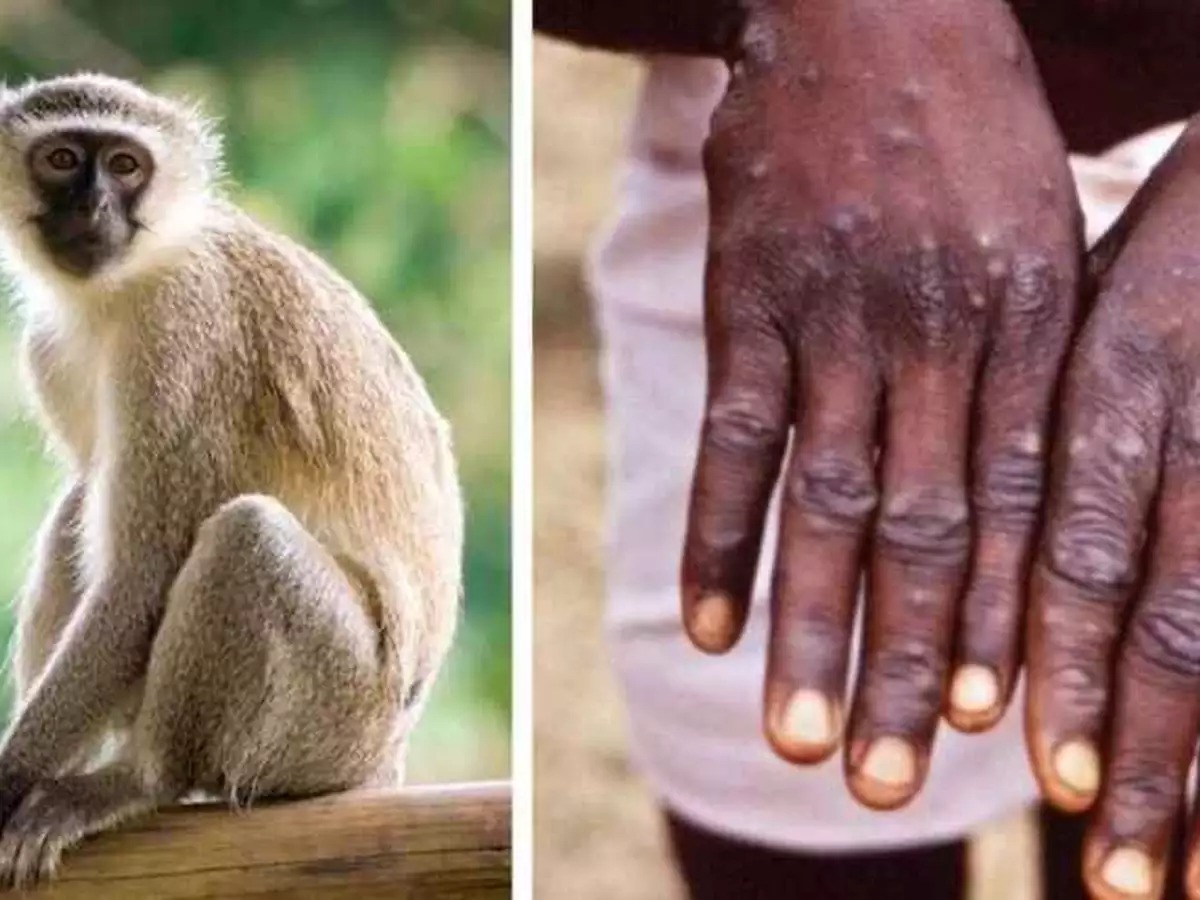 Primeiro caso de varíola dos macacos é confirmado no Brasil