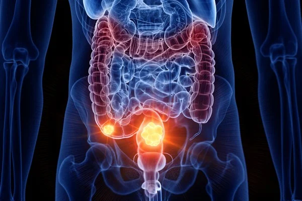 Mudanças na evacuação podem ser câncer de intestino; saiba sintomas