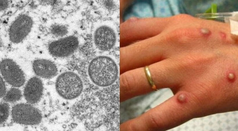 Varíola dos macacos: médicos relatam alta de casos em homens gays e bissexuais