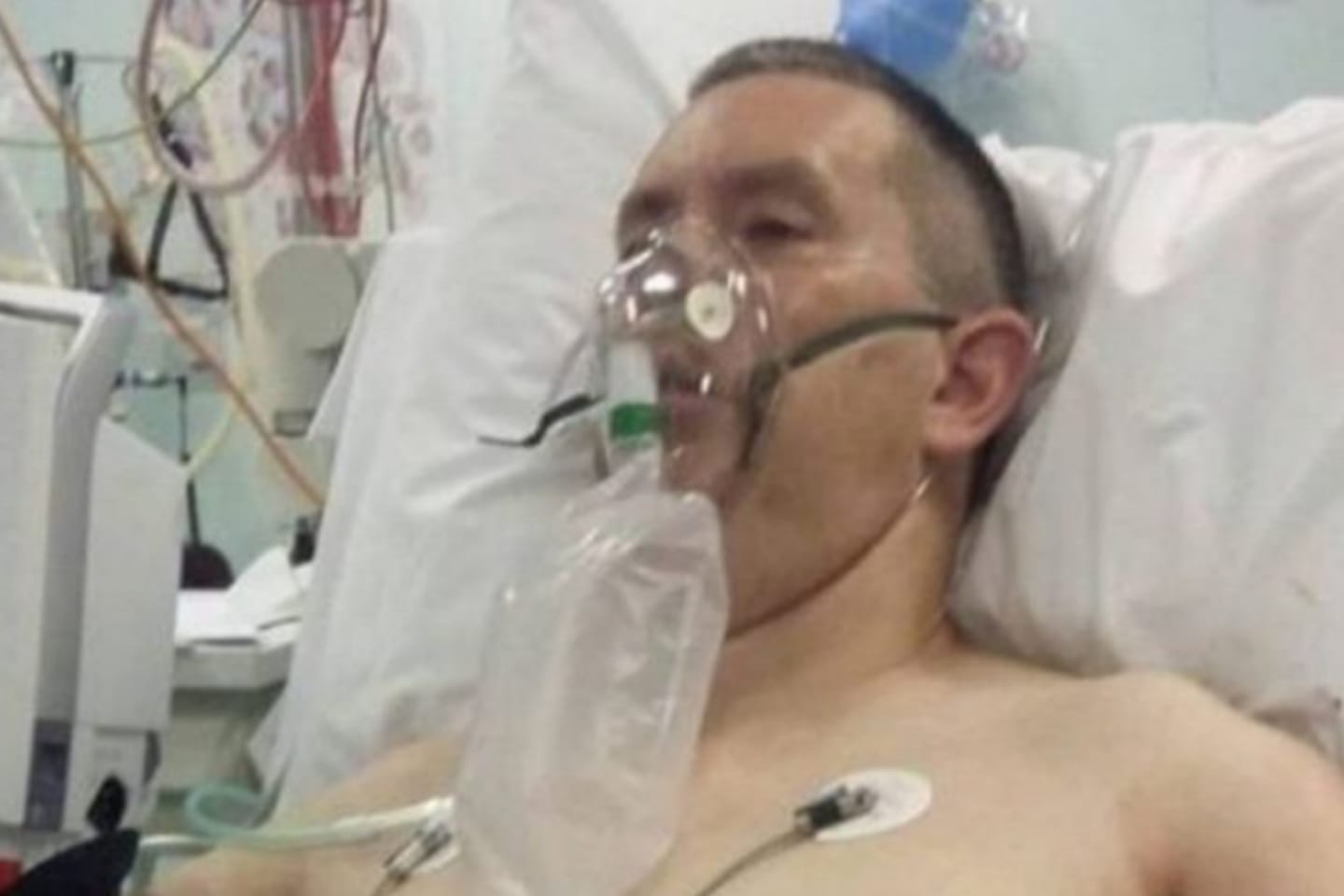 Homem tem costelas perfuradas e pulmão colapsado após ataque de arraia