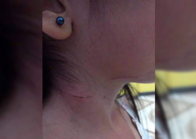 Mais uma criança tem pescoço cortado com linha de pipa no Pará