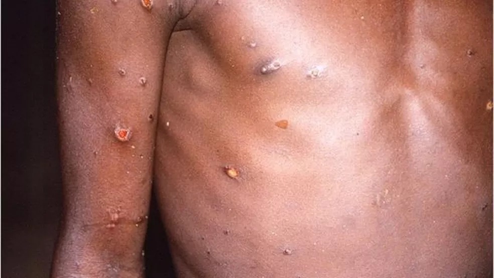 Parauapebas apresenta primeiro caso suspeito de Monkeypox
