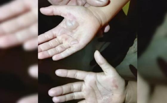 Mãe queima mãos das próprias filhas com colher quente por causa de leite condensado