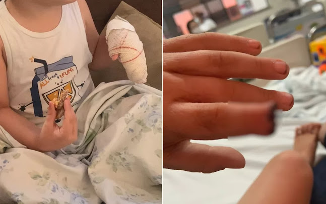 Criança tem parte do dedo amputado após ter mão prensada em armário de escola