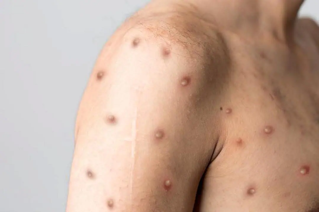 “Varíola dos macacos” não deve ser confundida com doenças dermatológicas, alerta especialista