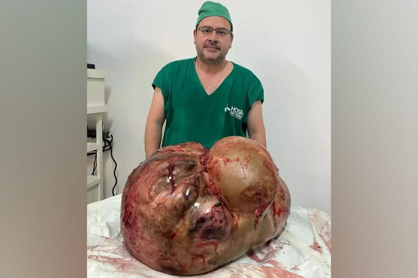 Médico retira tumor de 46 kg de mulher em cirurgia de emergência