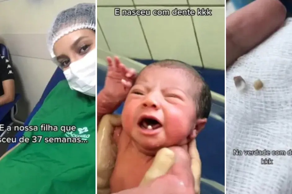 VÍDEO: Bebê nasce com dois dentes e surpreende médicos no Pará