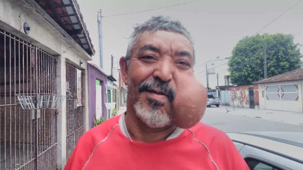 Pedreiro que carregava cisto gigante no rosto é encontrado morto