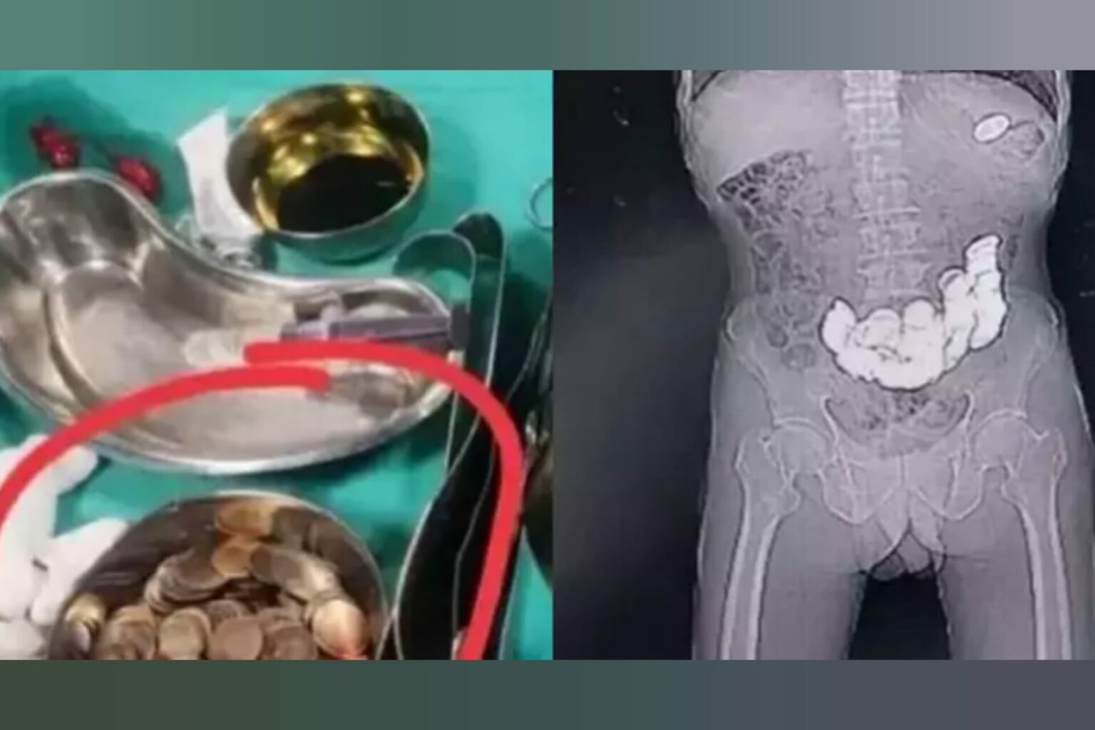 Homem passa por cirurgia no estômago após engolir 187 moedas