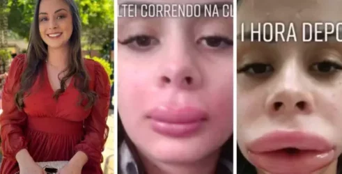 VÍDEO: Jovem fica irreconhecível após preenchimento labial