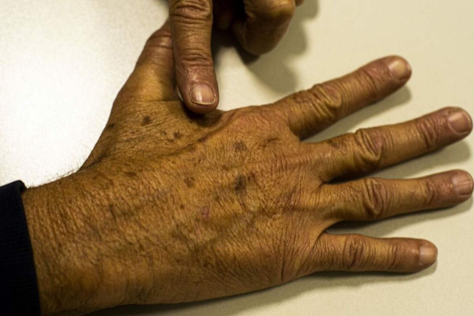Sociedade médica lança campanha sobre prevenção do câncer de pele