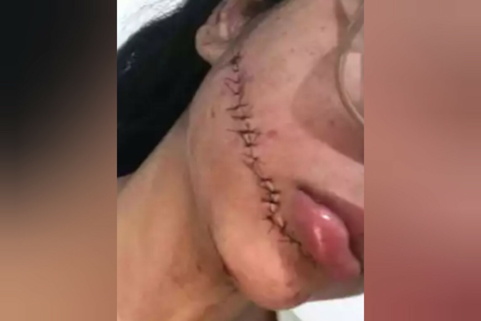 Estudante de enfermagem tem rosto cortado enquanto dormia em viagem de ônibus