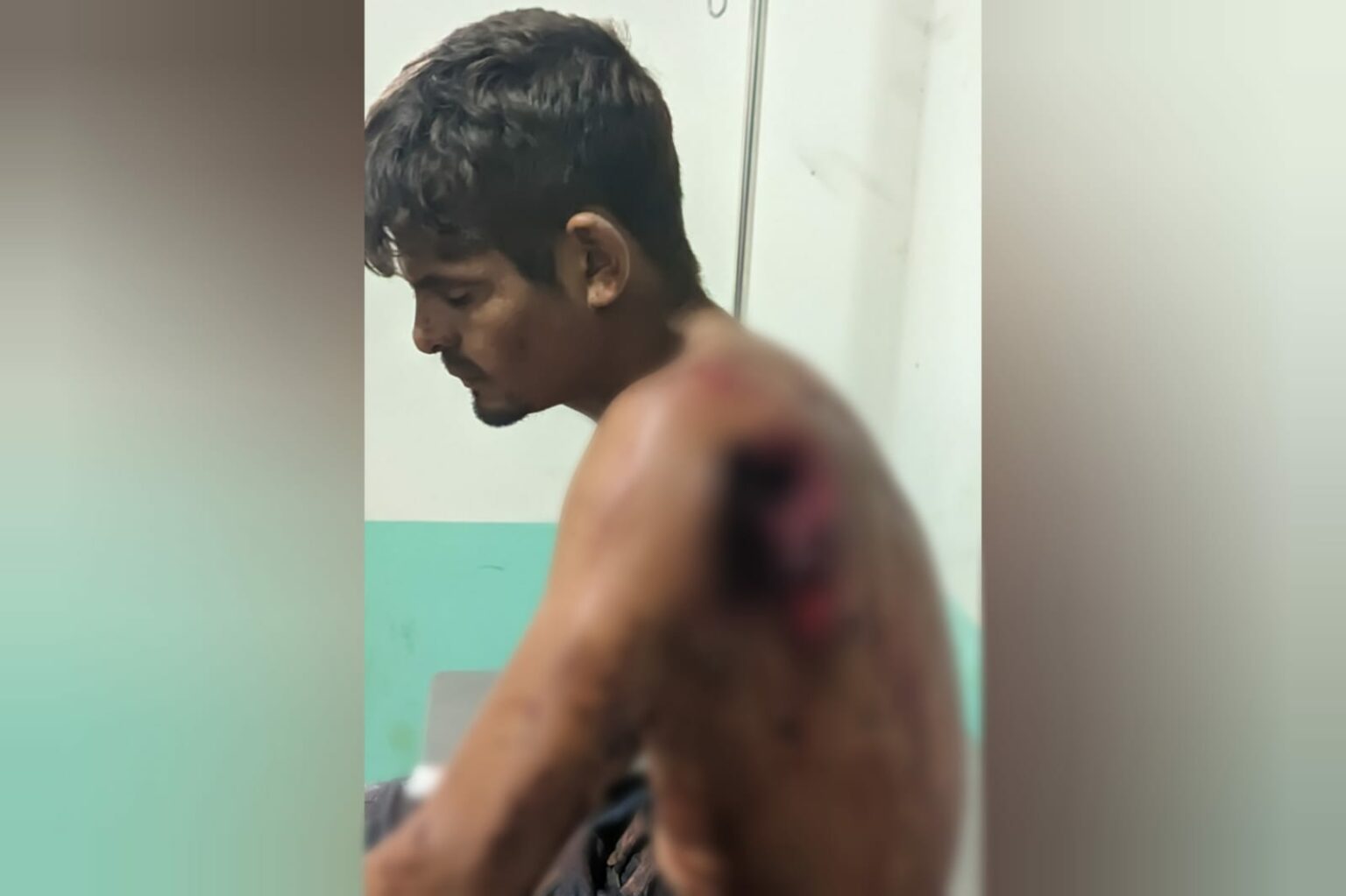 Tiro de espingarda arranca omoplata de jovem próximo a Marabá