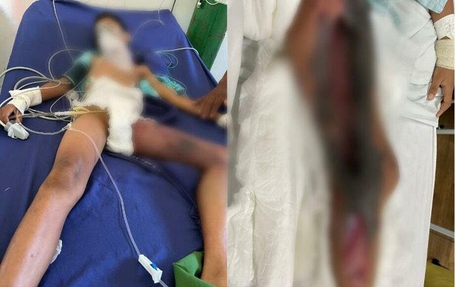Criança de 11 anos é picada por cobra e corre risco de perder a perna, no Pará