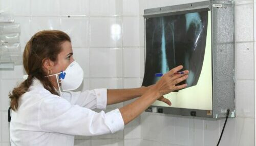 Com aumento de 5%, Brasil registra 78 mil casos de tuberculose