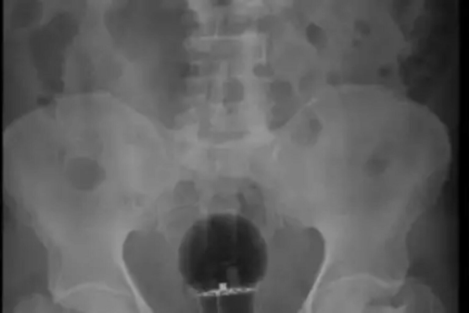 Homem passa por cirurgia para retirar lâmpada do ânus