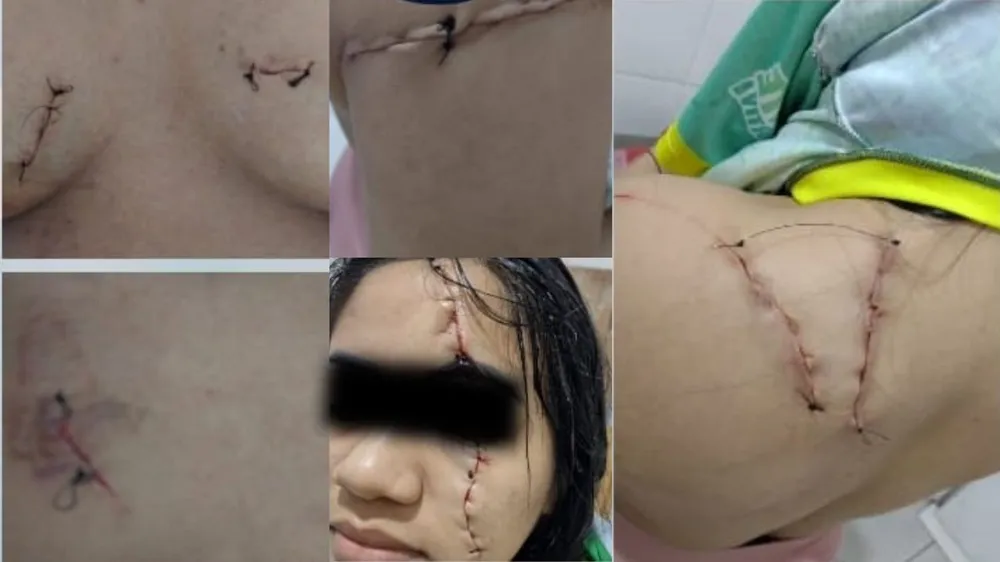 Mulher sofre ataque a golpes de bisturi ao sair de academia no nordeste do Pará