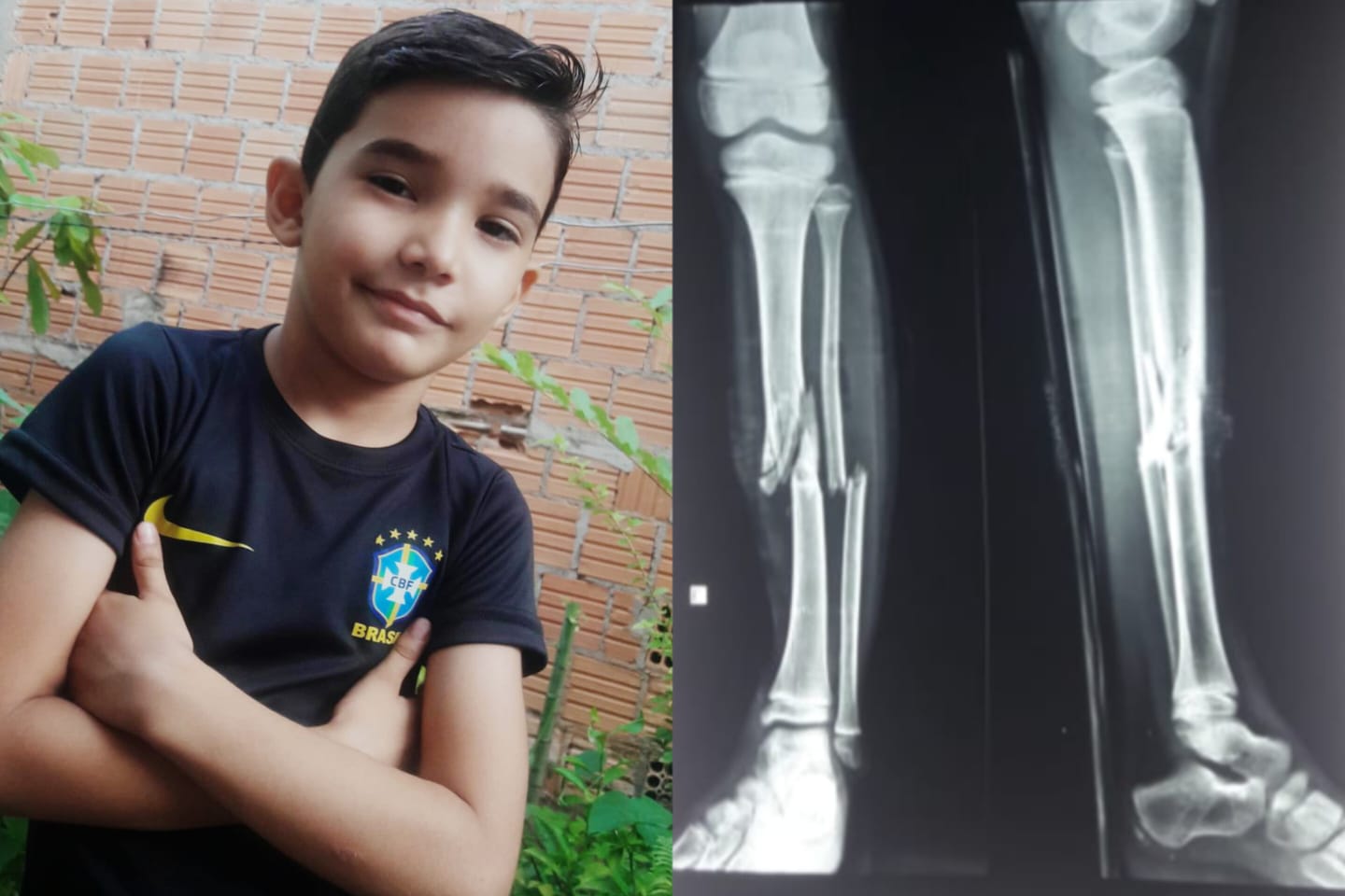 Família pede ajuda para tratamento de criança atropelada em Marabá