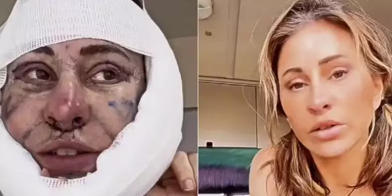 Mulher de 50 anos gasta R$ 73 mil em cirurgia plástica para ‘voltar aos 30’