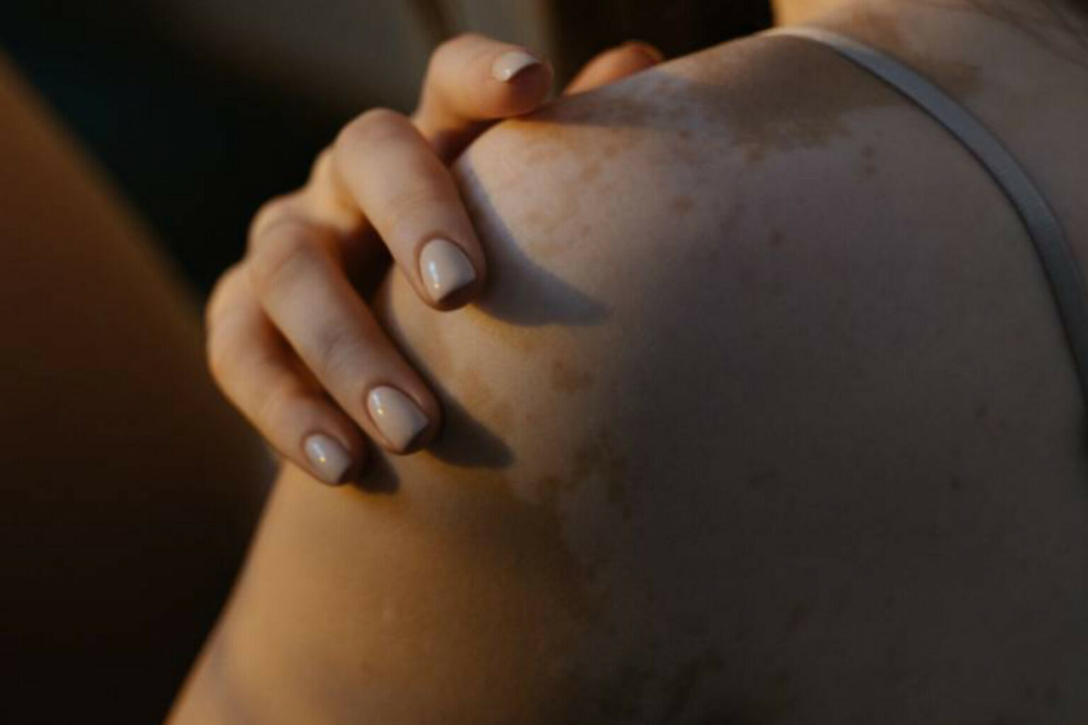 Sespa orienta para atendimento contra o vitiligo pelo SUS