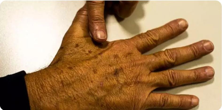 Pará registra quase 300 casos de câncer de pele em mais de 6 meses