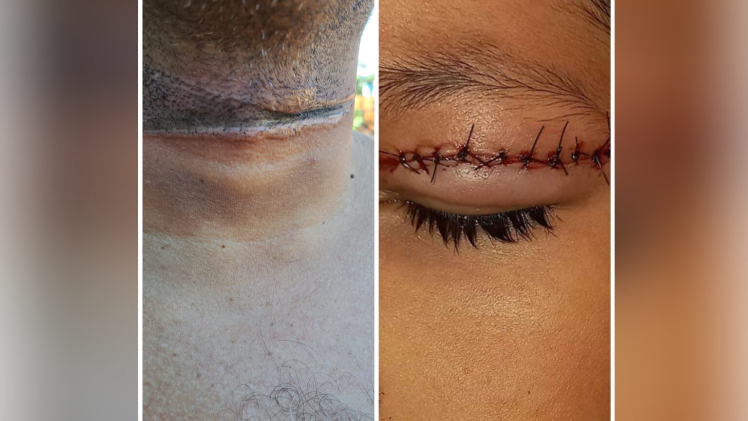 Criança e mototaxista têm pálpebra e pescoço cortados por linha de cerol em Marabá