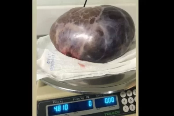 Em cirurgia de emergência, médicos retiram tumor de 5 kg de paciente
