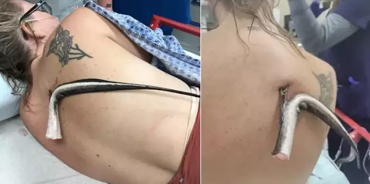 Banhista é ferida por ferrão de arraia nas costas durante lazer em praia