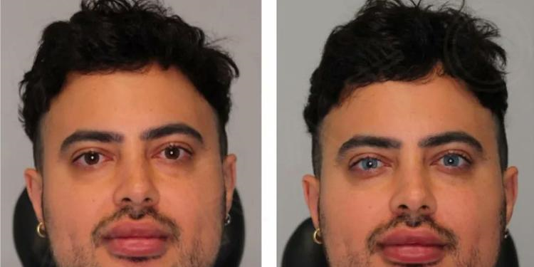 Homem viraliza ao realizar procedimento para alterar cor dos olhos
