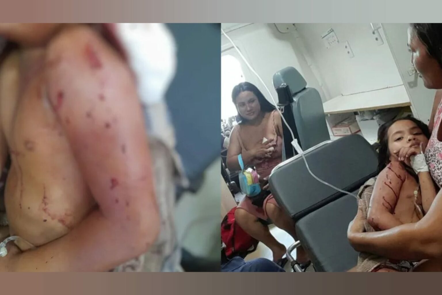 Mãe e filha são atacadas pelo próprio cachorro da raça pitbull no Pará