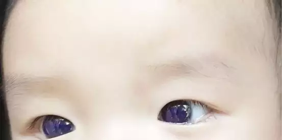 Bebê tem a cor dos olhos alterada após uso de medicamento contra covid-19