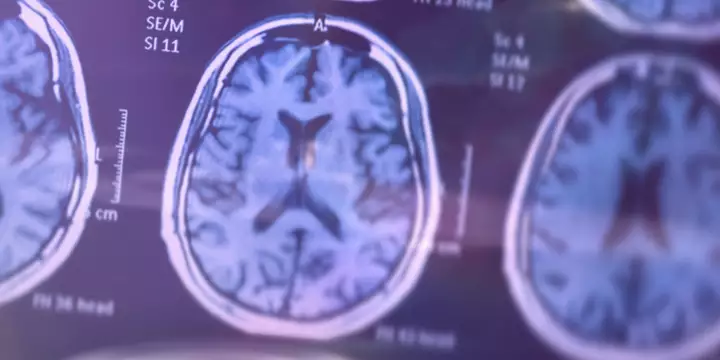 Brasil recebe primeiro exame de sangue para detectar Alzheimer