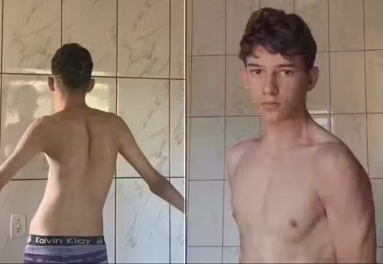 Vídeo: paraense realiza cirurgia de escoliose grave e resultado impressiona