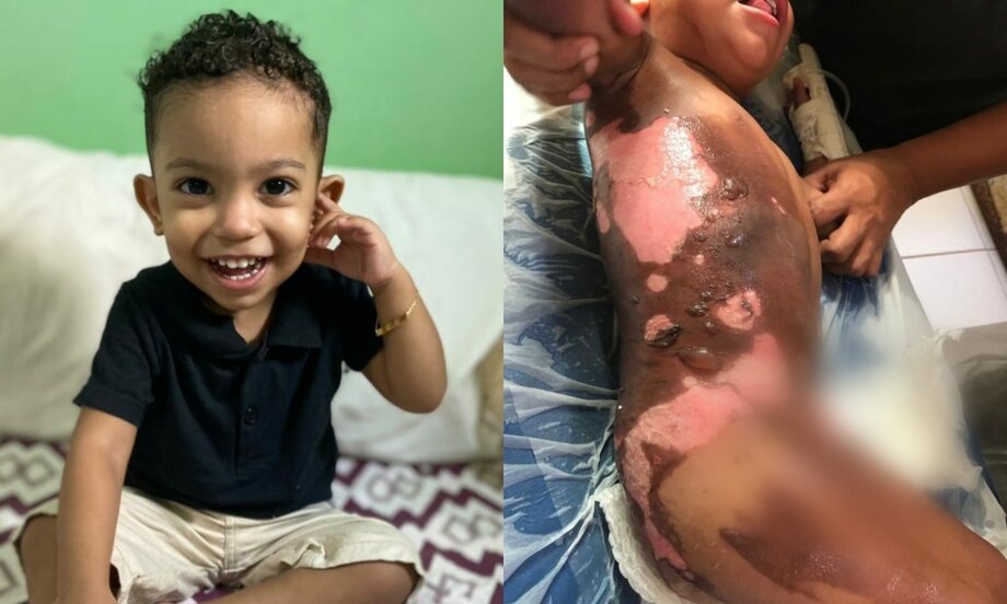 Criança de 2 anos sofre queimadura grave por água quente no Pará
