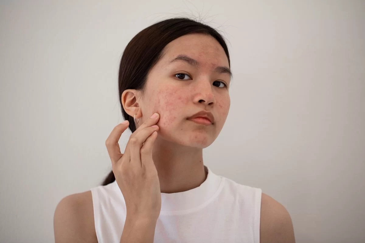 Sofre com a acne? Saiba quais são os grandes causadores do problema