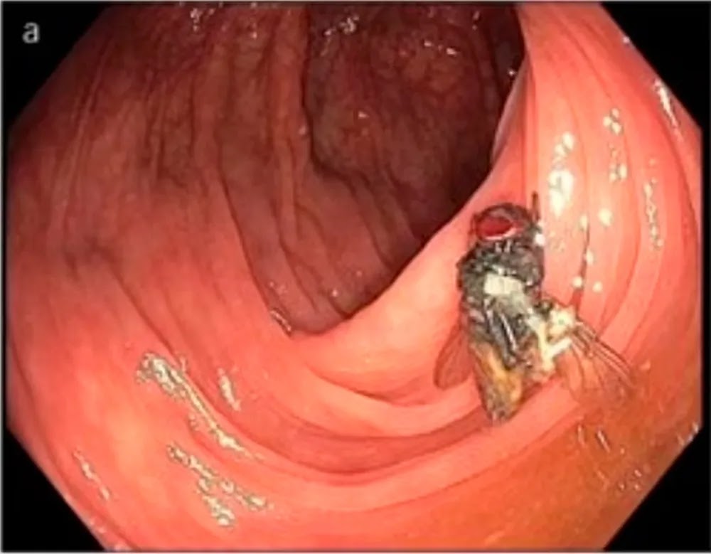 Mosca viva em intestino de paciente surpreende médicos durante colonoscopia nos EUA