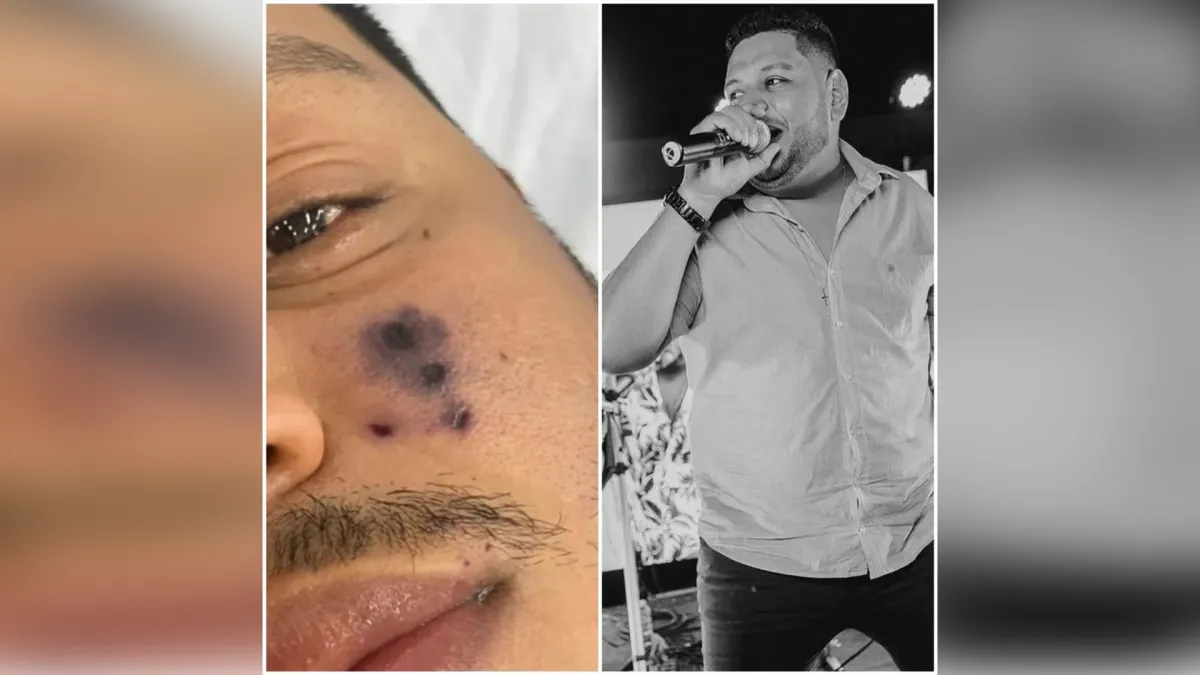 Cantor de Forró morre após ser picado por aranha no rosto
