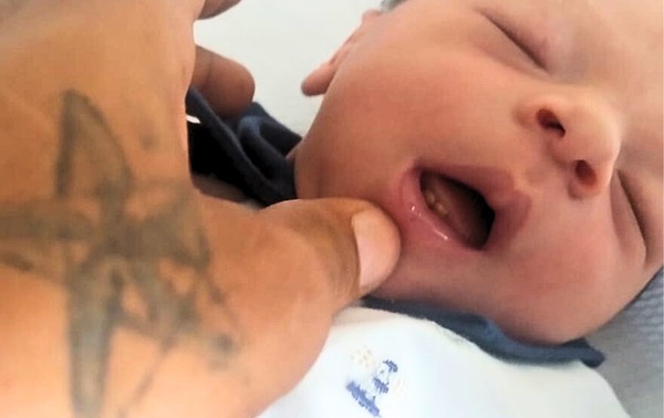 Bebê surpreende ao nascer com dentes em São Paulo