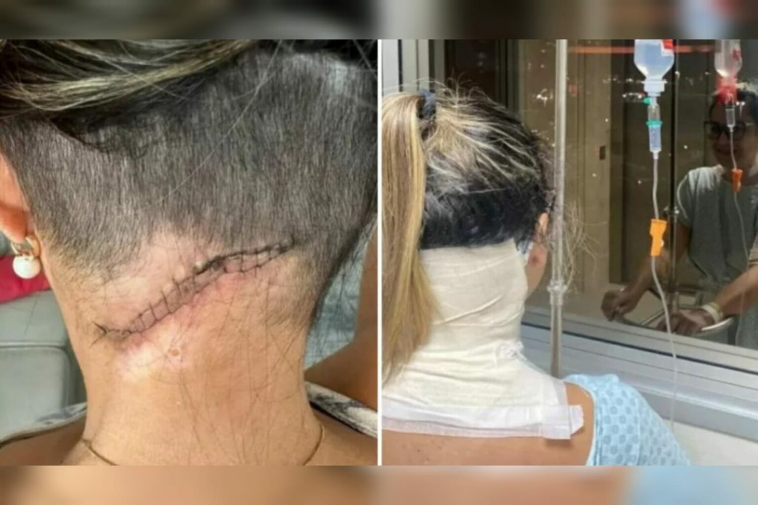 Mulher fica internada e passa por cirurgias após espremer espinha