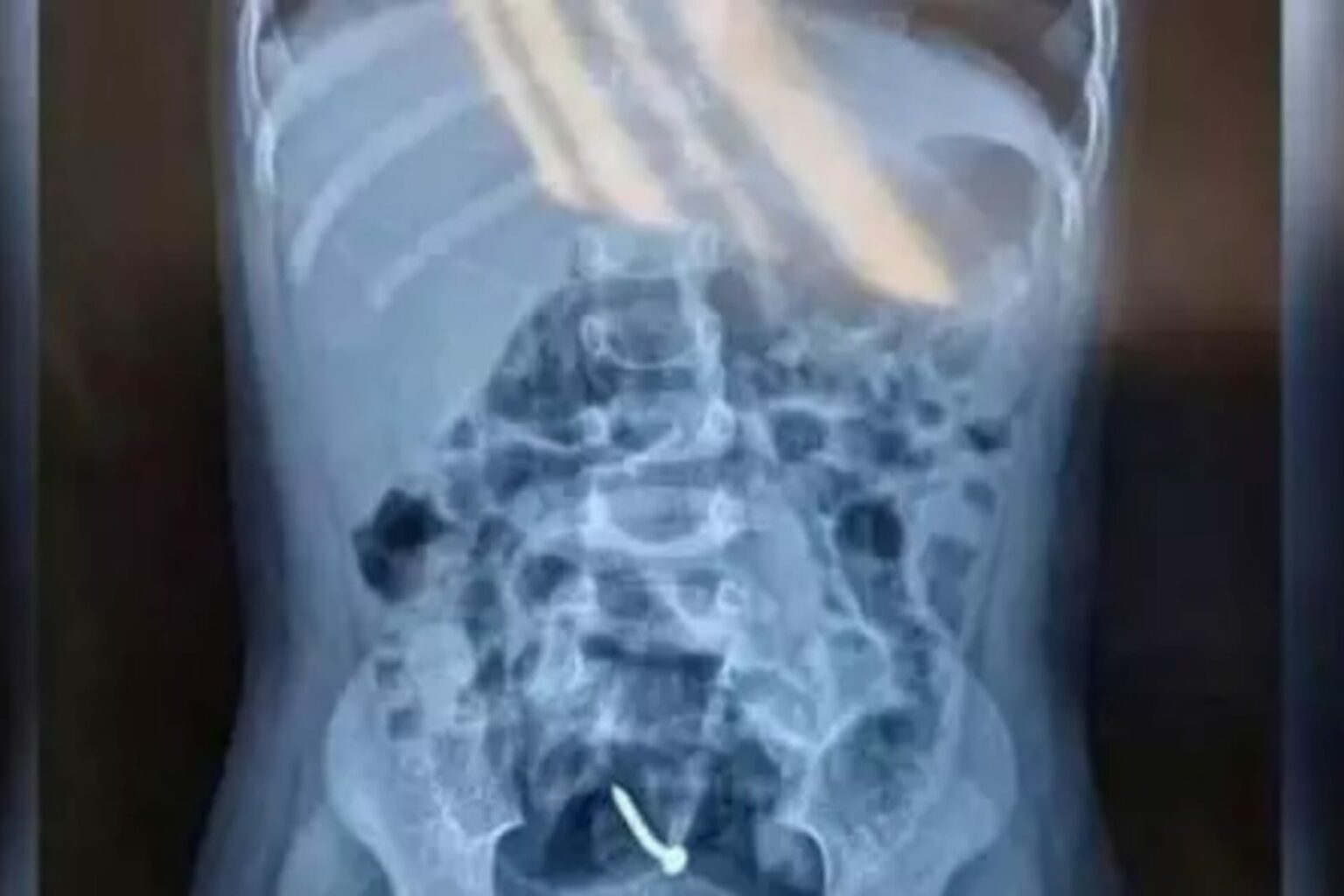 Parafusos e pregos são encontrados dentro de criança estuprada pelo pai